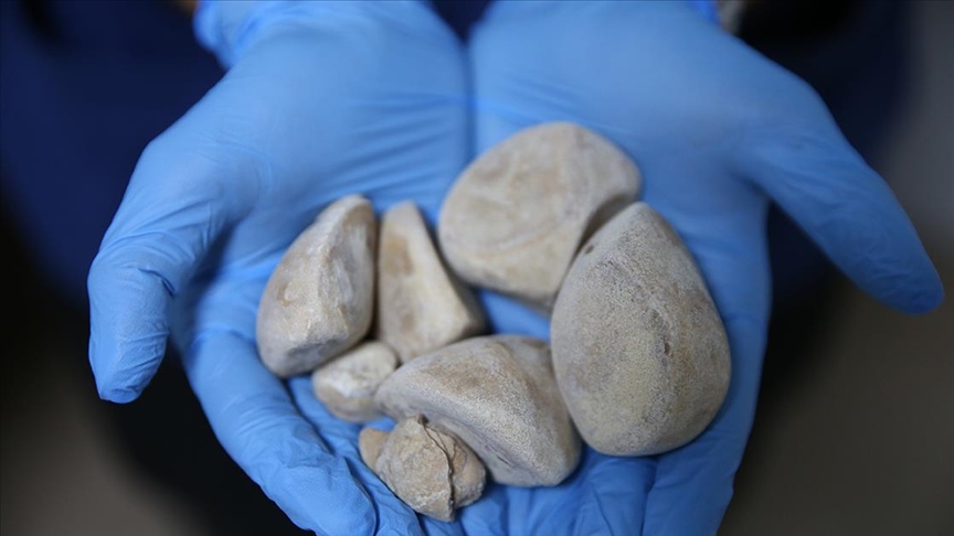 İdrar kanalı ve mesanesinden yarım kilogram ağırlığında 6 taş çıkarıldı