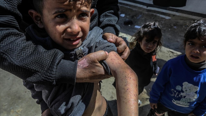 В Газе распространяются кожные заболевания из-за нехватки воды и антисанитарии