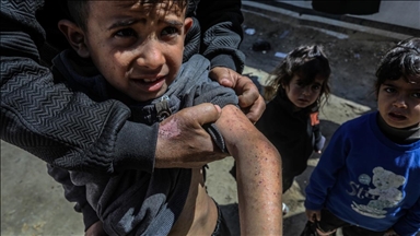 В Газе распространяются кожные заболевания из-за нехватки воды и антисанитарии