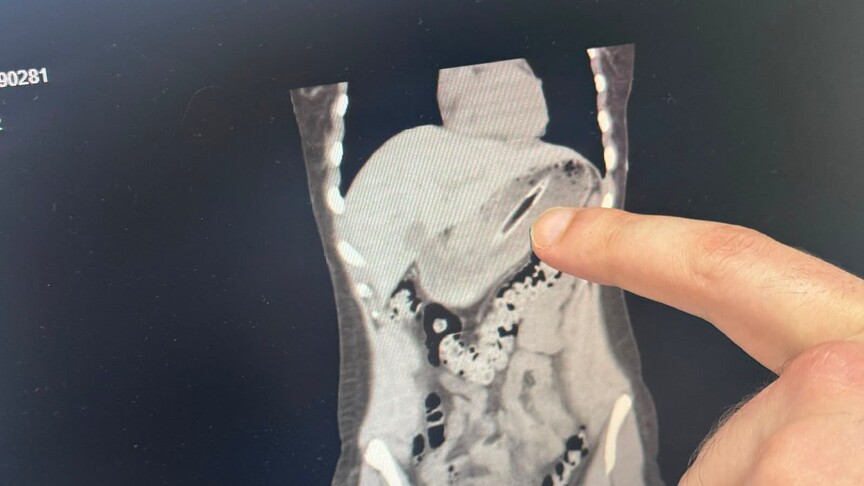 Zayıflamak için kendini kusturmaya çalışırken diş fırçası yuttu
