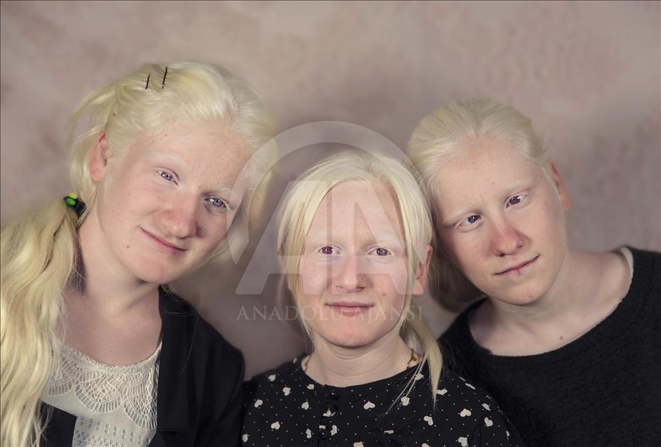Problemi albino populacije: Najviše nas bole znatiželjni pogledi na ulici 