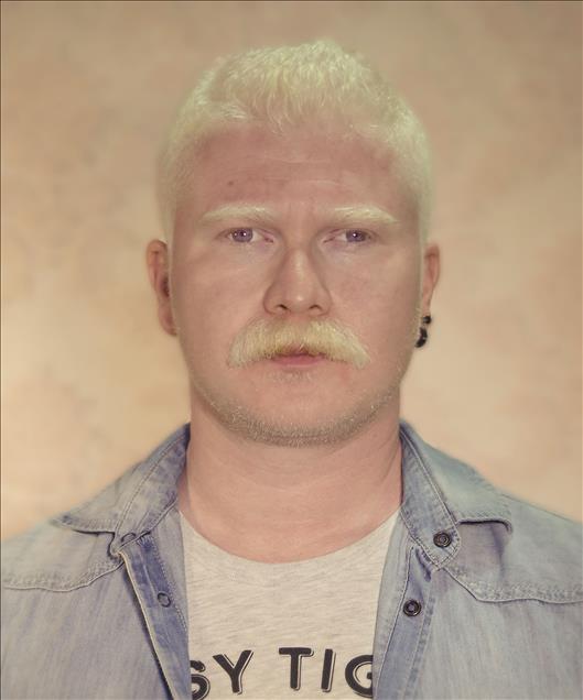 Albinos of Turkey