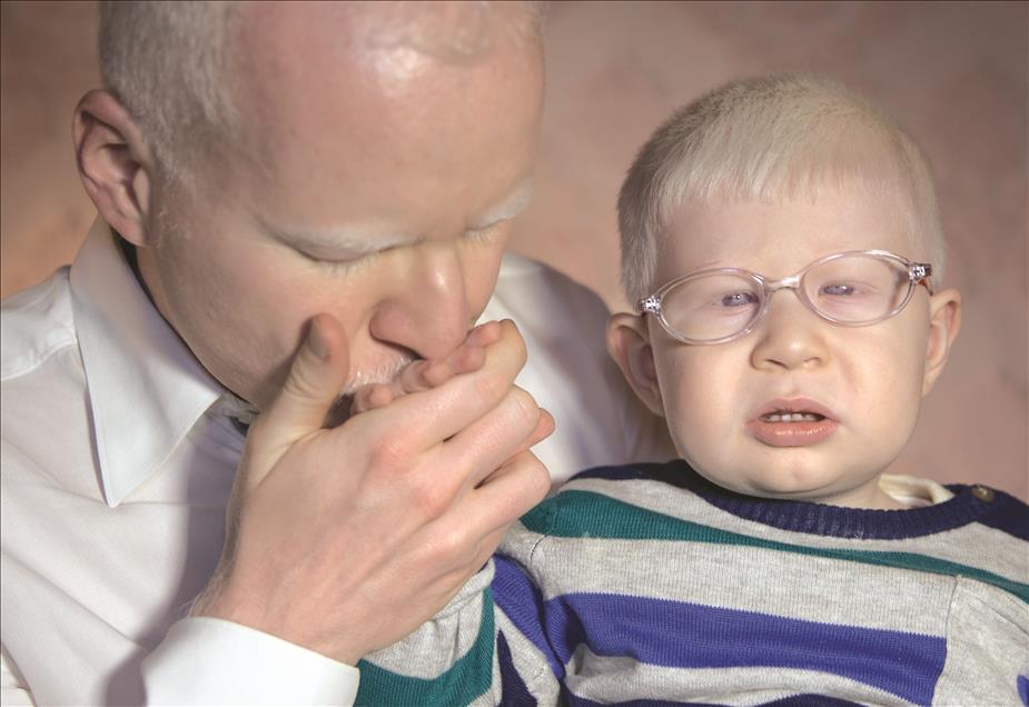 Albinos of Turkey