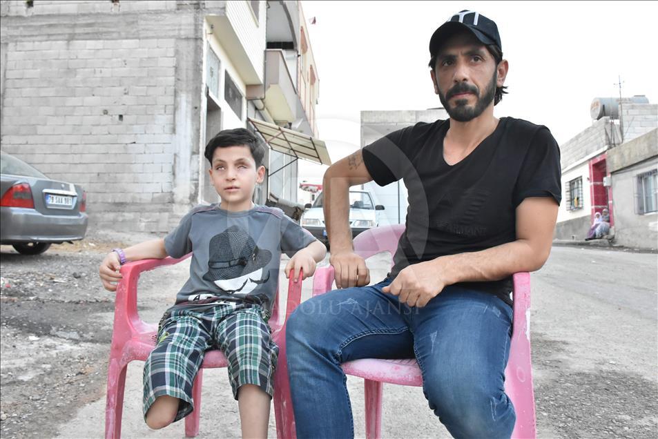 Amputé d’une jambe dans l’explosion d’une bombe de Daech, un enfant syrien veut avoir une prothèse 
