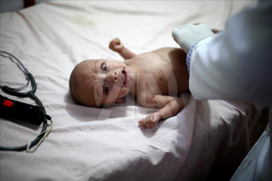 Malnutrition kills 2 babies in Syria’s Eastern Ghouta