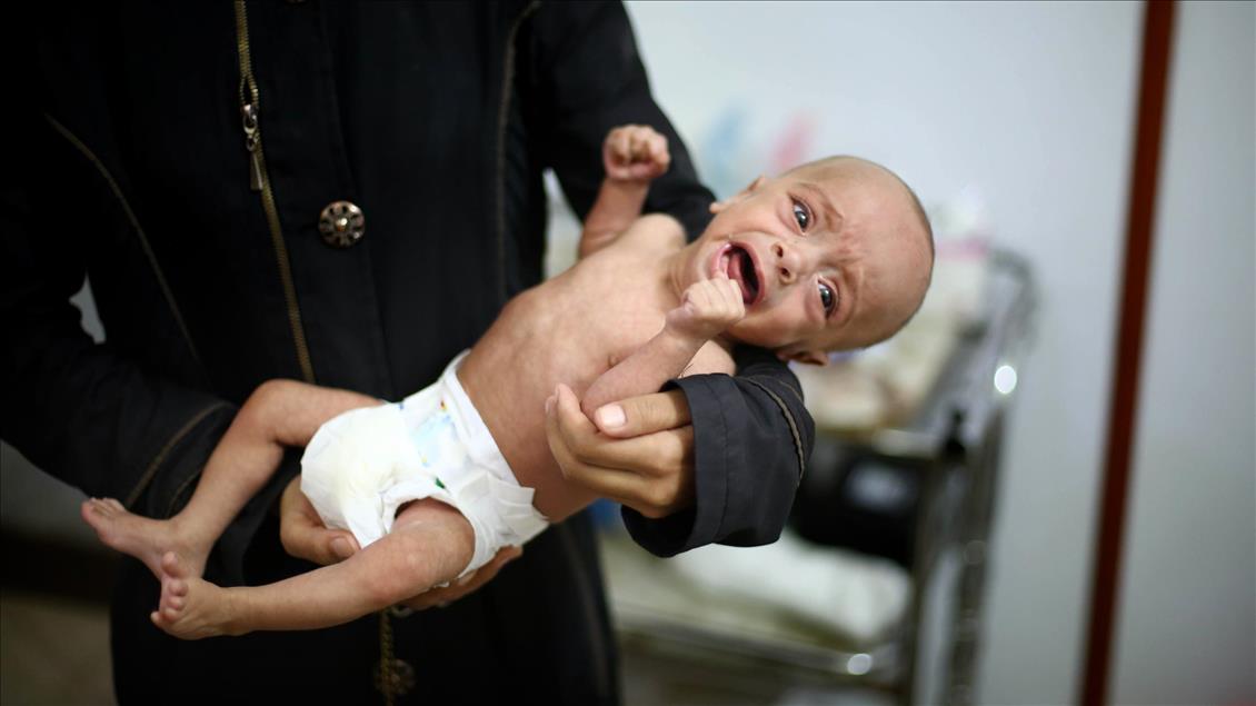 Malnutrition kills 2 babies in Syria’s Eastern Ghouta