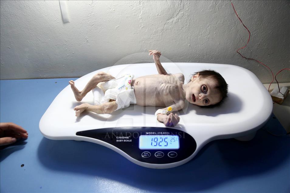 Malnutrition kills 2 babies in Syria’s Eastern Ghouta