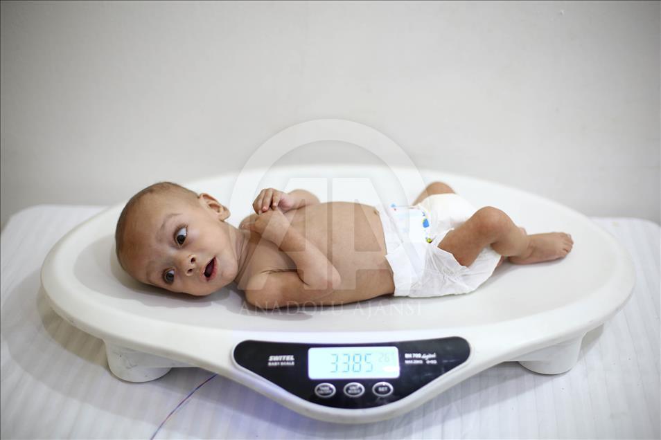 Malnutrition kills 2 babies in Syria’s Eastern Ghouta