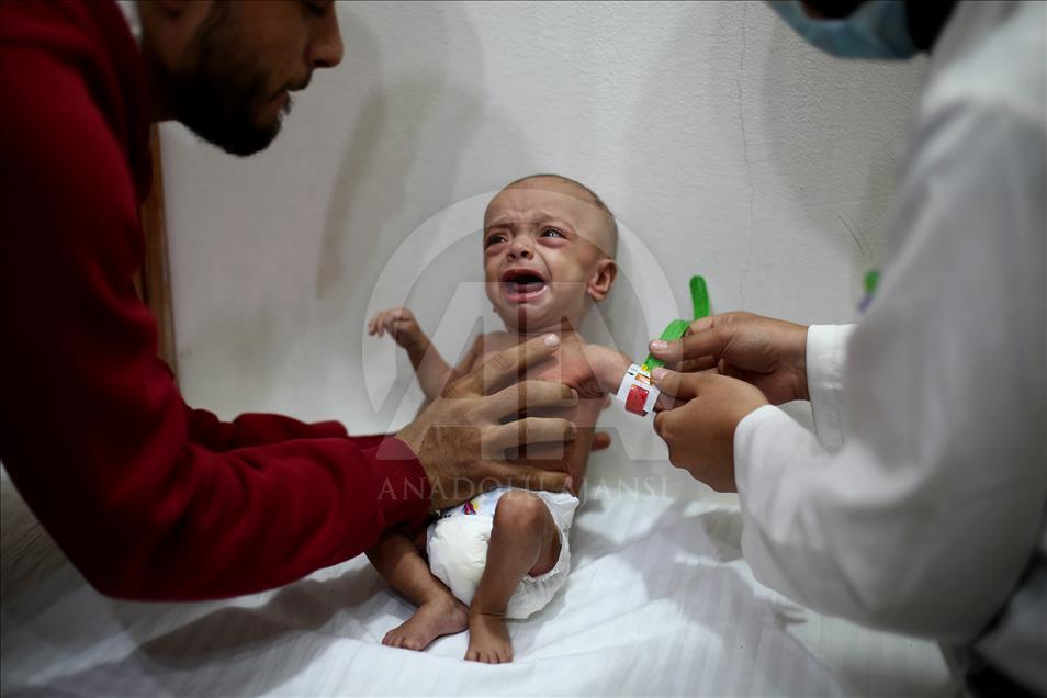 Malnutrition kills 2 babies in Syria’s Eastern Ghouta