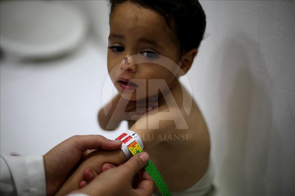 Malnutrition kills 2 babies in Syria’s Eastern Ghouta