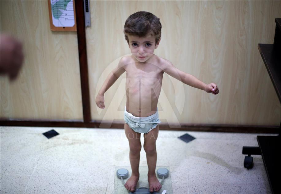 Malnutrition kills 2 babies in Syria’s Eastern Ghouta