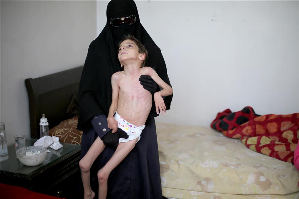 Syrian child suffers from hunger