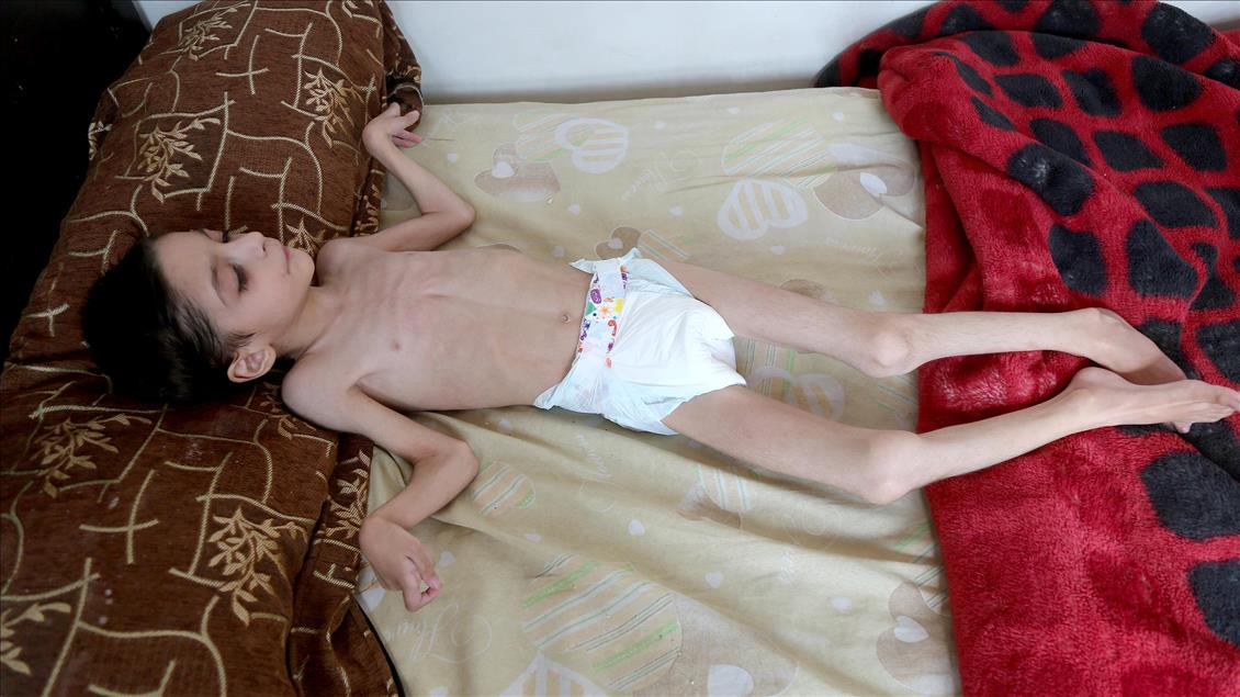 Syrian child suffers from hunger