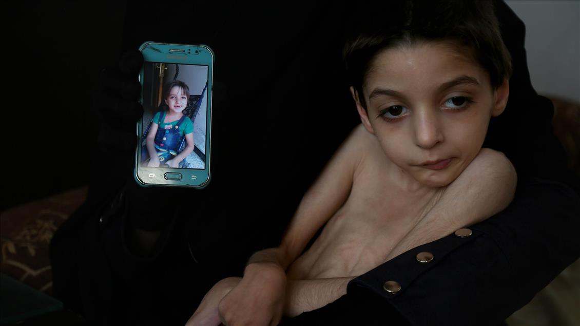 دختربچه سوری به دلیل نبود غذا با مرگ دست‌وپنجه نرم می‌کند