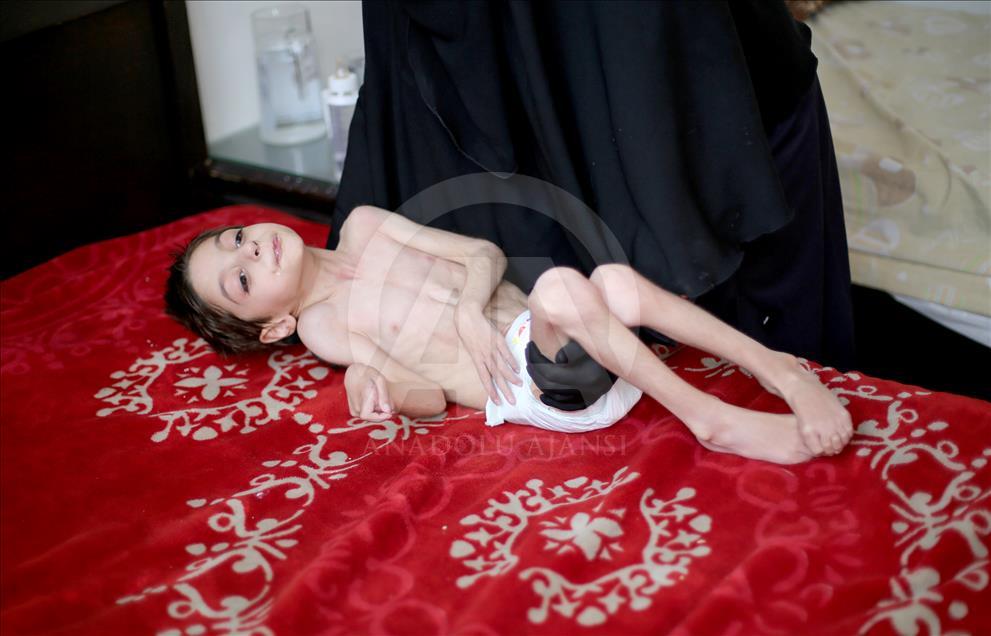 دختربچه سوری به دلیل نبود غذا با مرگ دست‌وپنجه نرم می‌کند