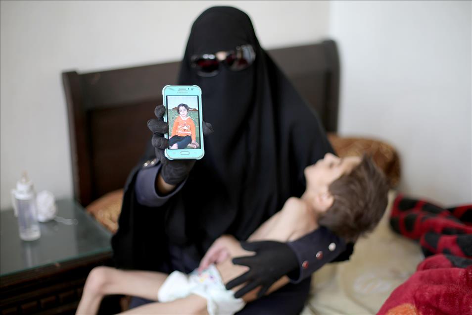 Syrian child suffers from hunger