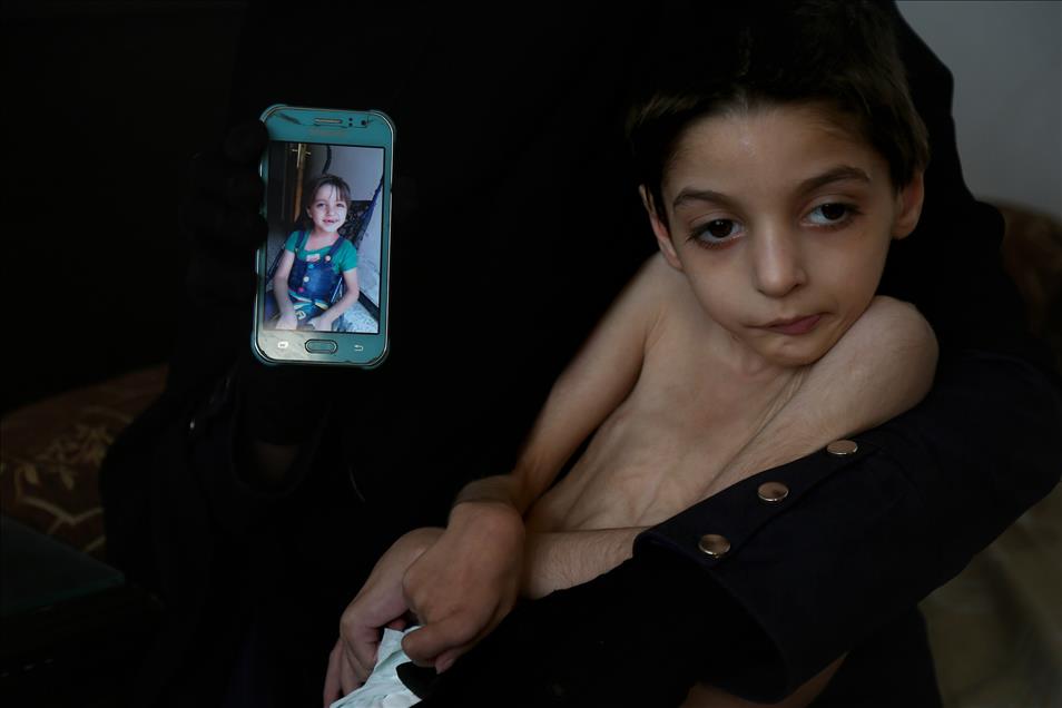 Syrian child suffers from hunger