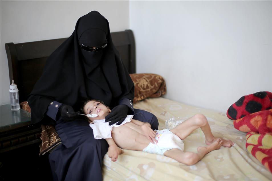 Syrian child suffers from hunger
