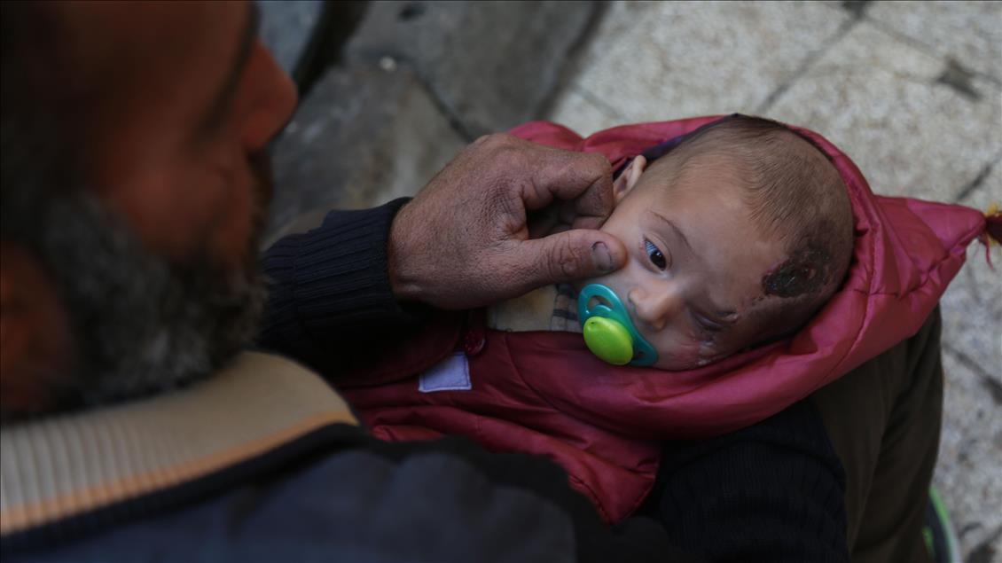A miraculous struggle for life of a Syrian baby in Eastern Ghouta