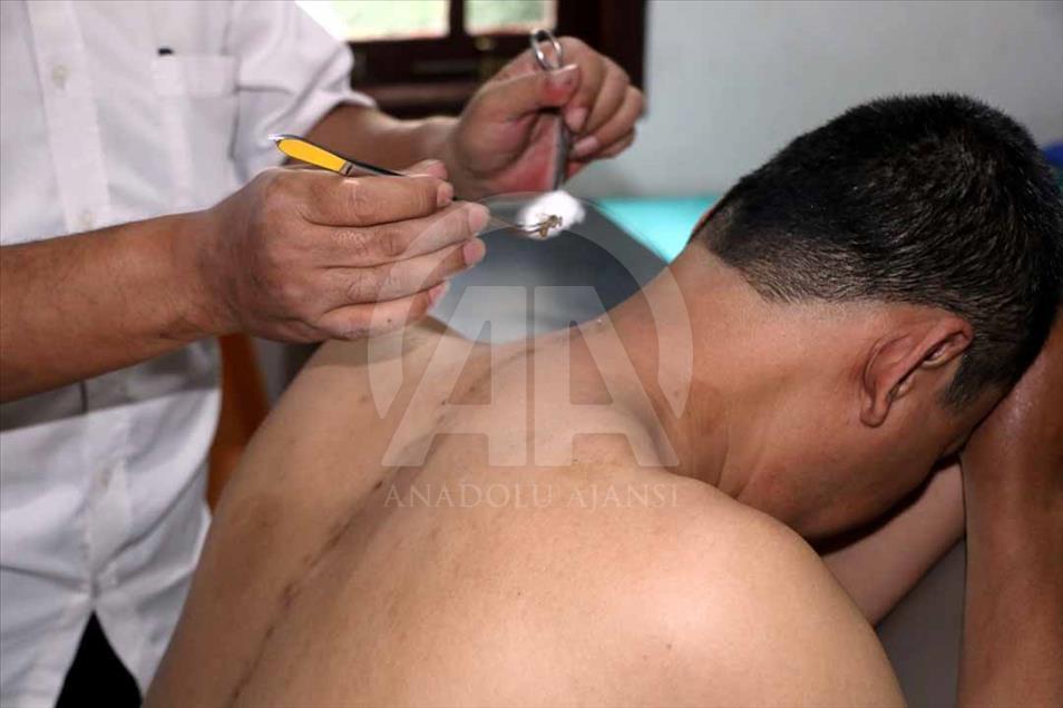 Indonesios fortalecen su sistema inmune con picaduras de abejas