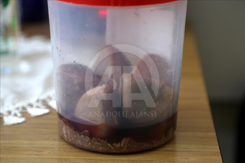 Mesanesinden 840 gram taş çıktı