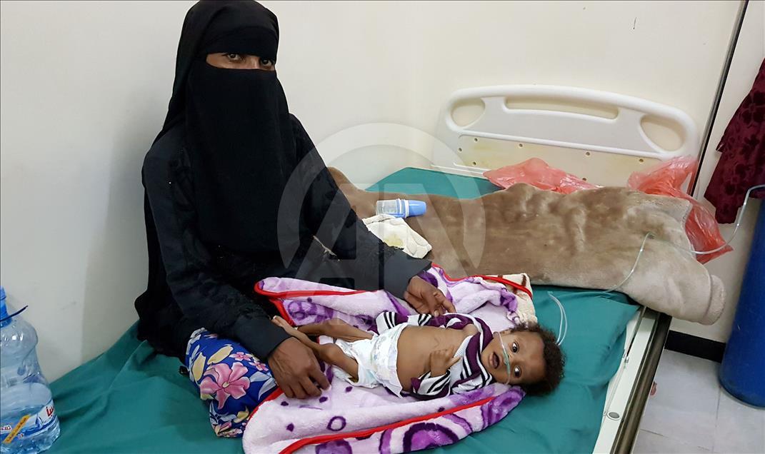 Yemen'de kıtlık en çok çocukları vuruyor