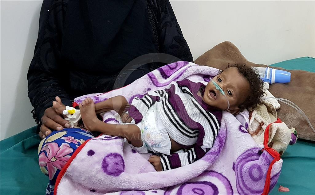 Yemen'de kıtlık en çok çocukları vuruyor