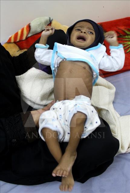 Yemen'de kıtlık en çok çocukları vuruyor