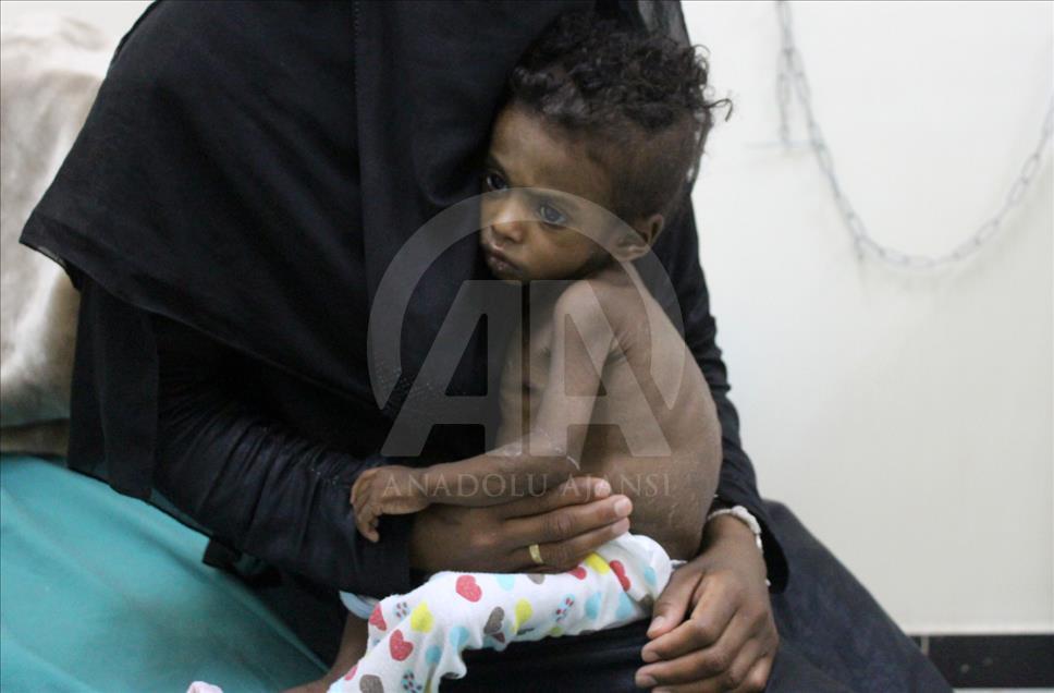 Yemen'de kıtlık en çok çocukları vuruyor