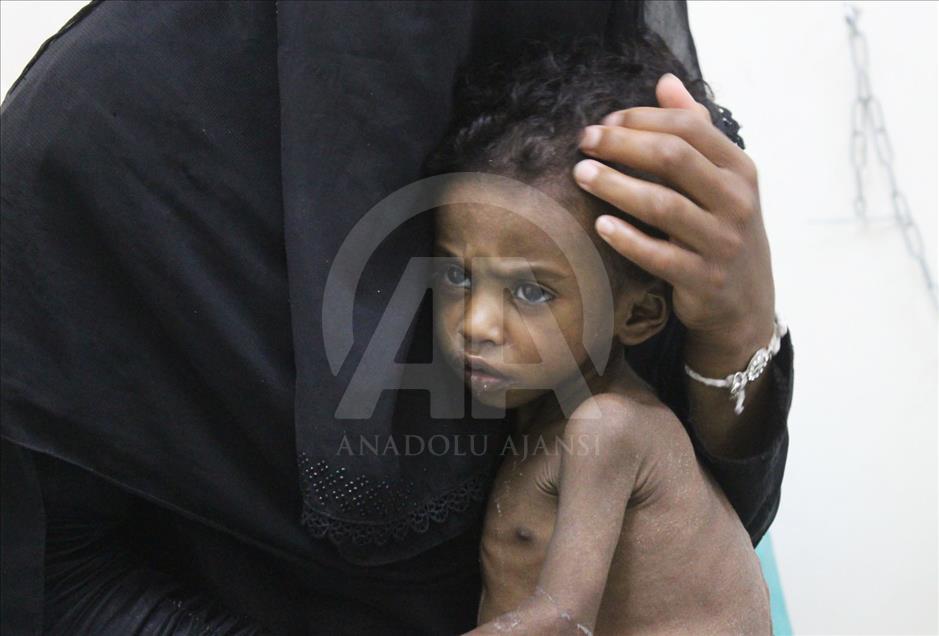 Yemen'de kıtlık en çok çocukları vuruyor