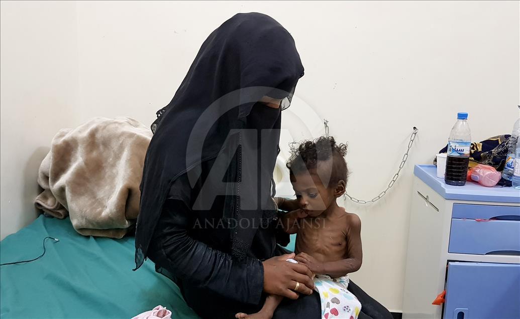 "جلد على عظم".. الجوع ينهش أطفال اليمن