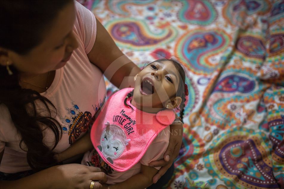 Generación del Zika, Microcefalia