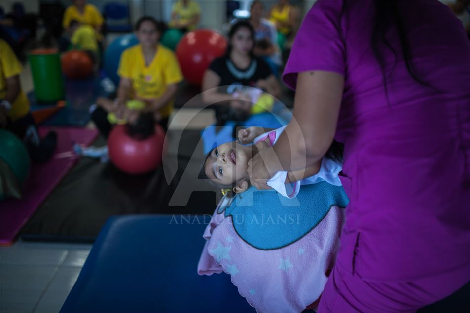 Generación del Zika, Microcefalia