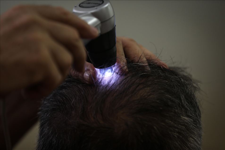 شركة تركية تطور علاجا للصلع كبديل لزراعة الشعر
