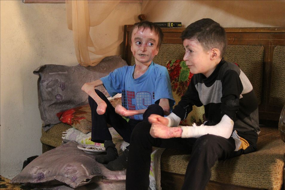 شابان سوريان بريف إدلب.. مرض نادر فاقمه قصف النظام