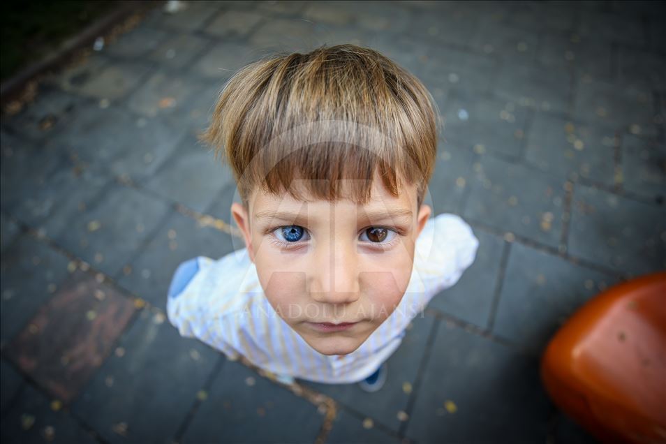 Children with Heterochromia in Turkey's Bursa