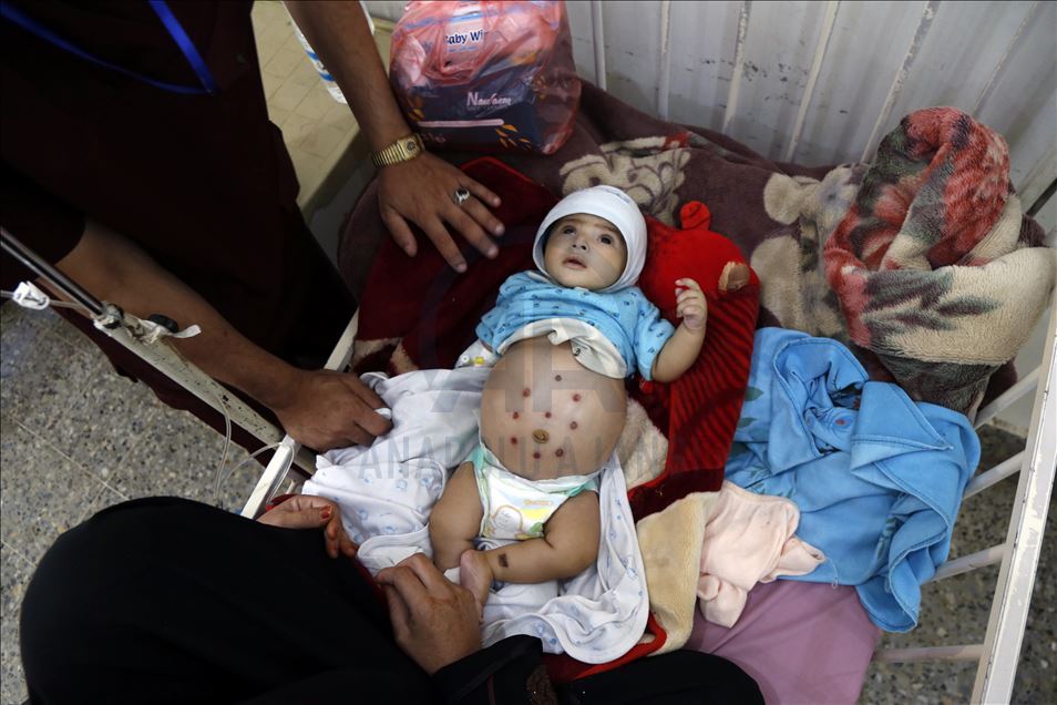 Humanitarian crisis increases day by day in Yemen
