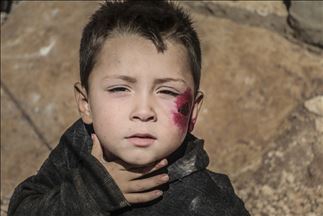 Leishmaniasis se propaga en los campos de refugiados en Idlib, Siria