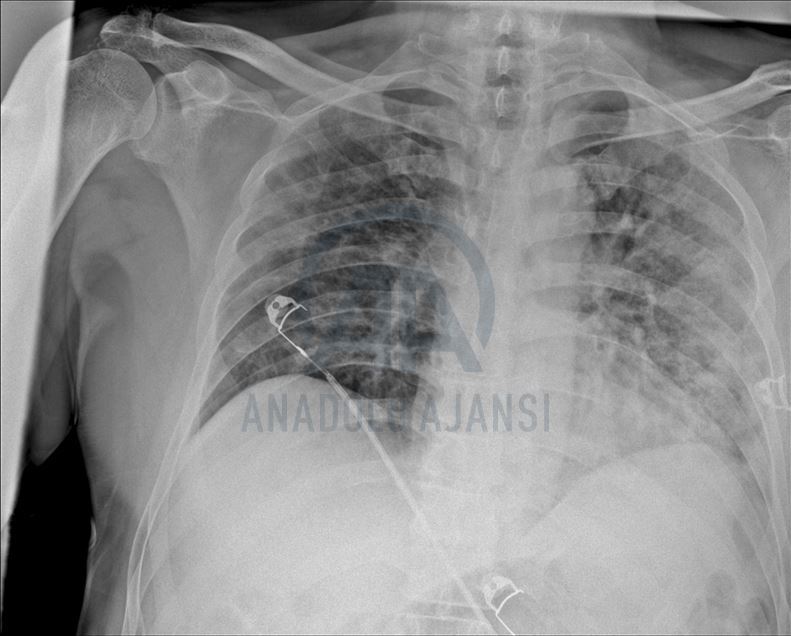 Koronavirüsün akciğerdeki ağır tahribatı, hastaların tomografi görüntülerine yansıdı