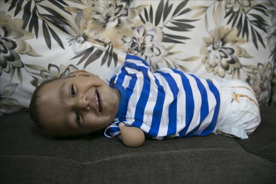 کودک 14 ماهه معلول سوری برای درمان به ترکیه منتقل شد