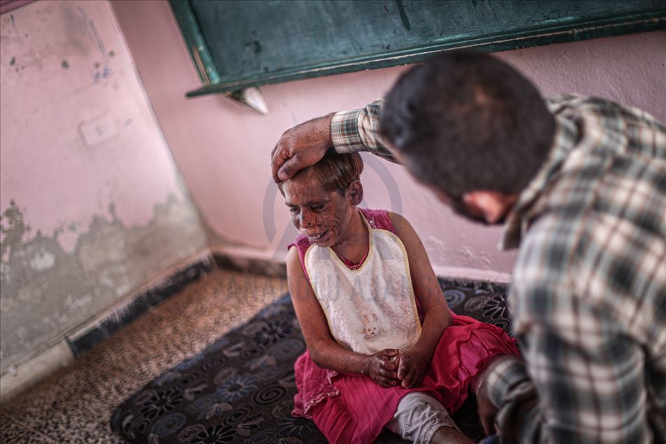 Niña siria necesita ayuda urgente para superar la difícil enfermedad de piel que padece