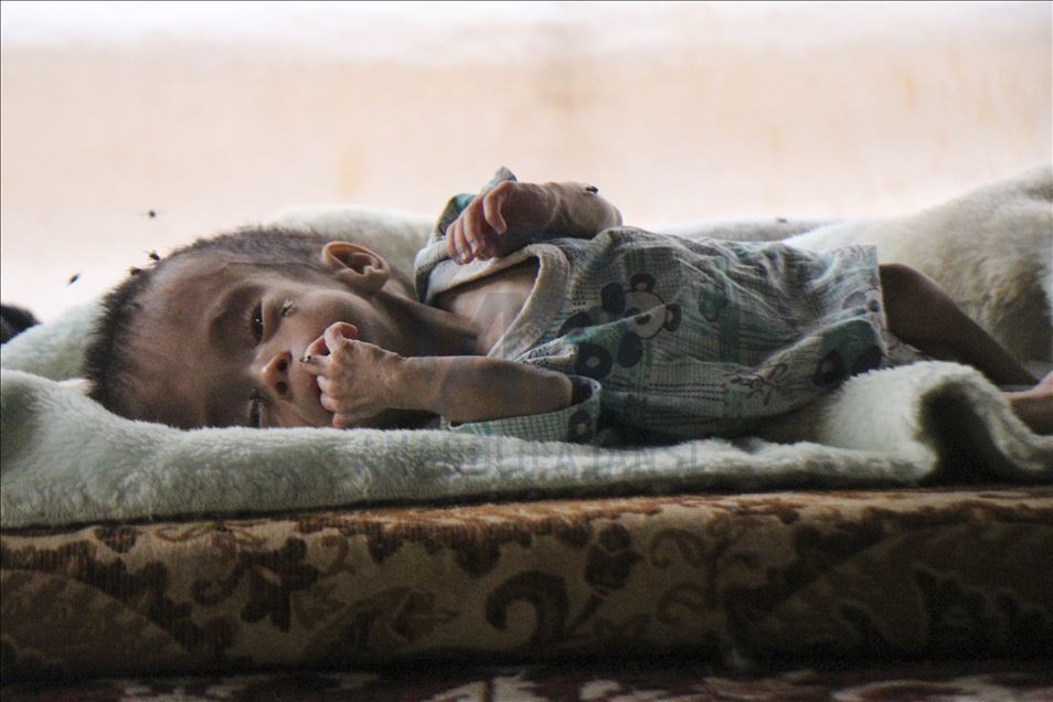 Bebé siria con espina bífida congénita espera ayuda para recibir tratamiento