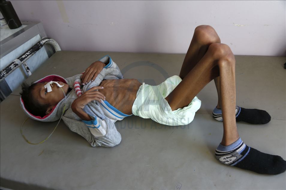 Yeryüzü Doktorları, Yemen'deki en büyük sorunun açlık krizi olduğunu açıkladı