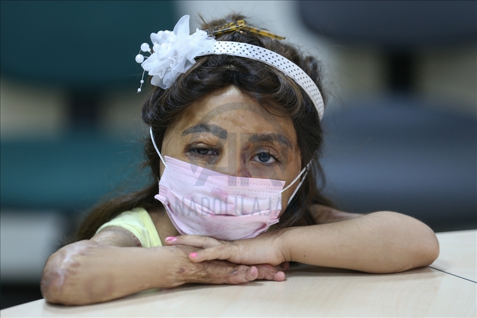 Syrian Hana's face laughed with tissue transplantation