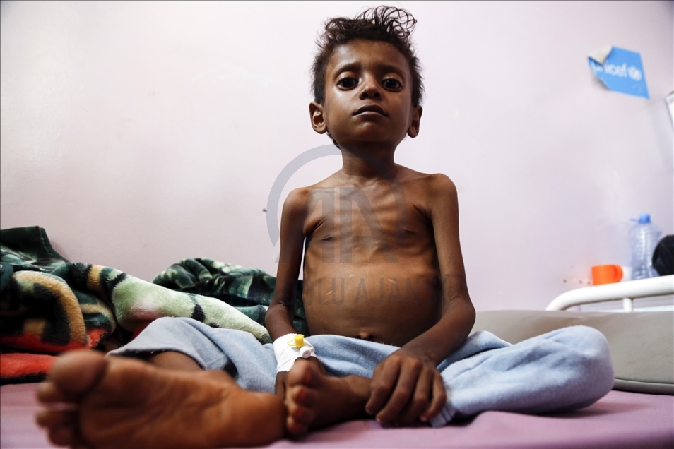 Millions of children confront threat of starvation in Yemen - Anadolu ...