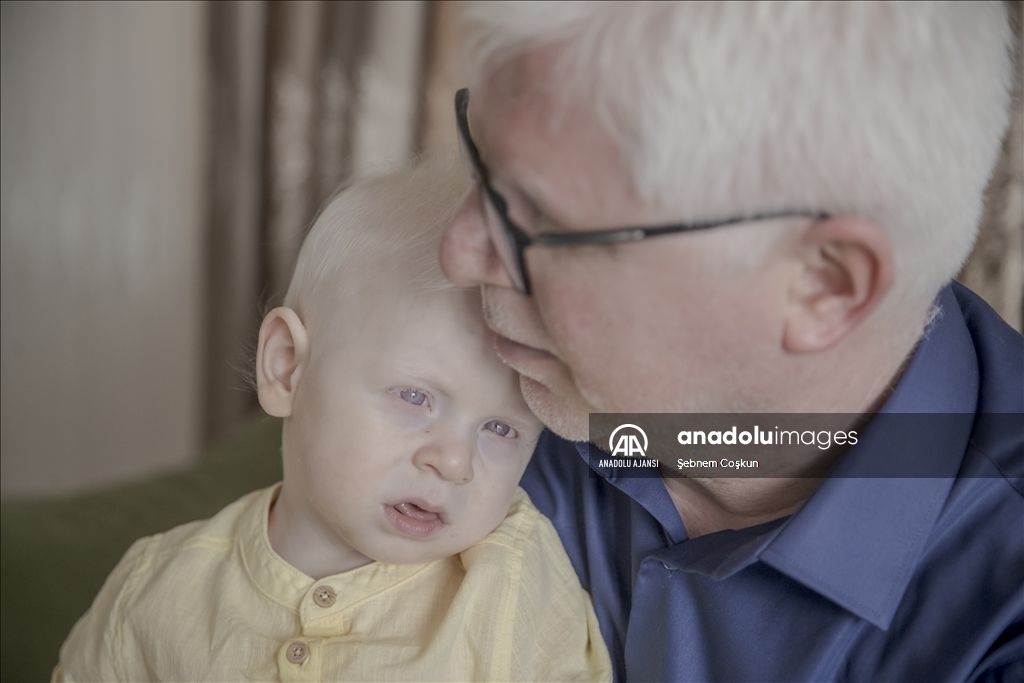 Öğretmen ve müezzin çift kendileri gibi iki çocuklarıyla albinizmlilere örnek oluyor