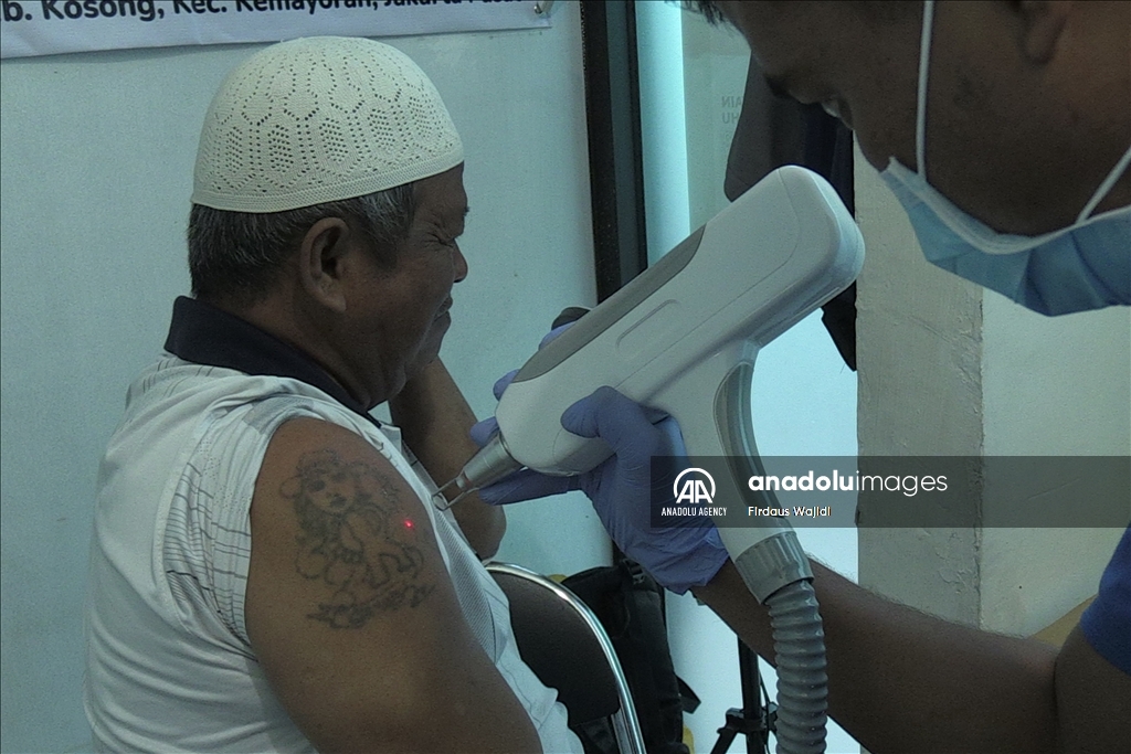 Program hapus tato gratis support Muslim untuk Hijrah