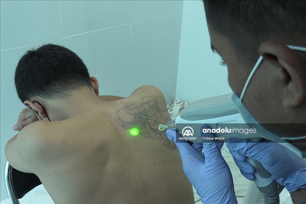 Program hapus tato gratis support Muslim untuk Hijrah