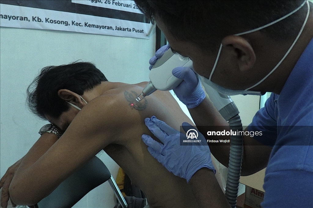 Program hapus tato gratis support Muslim untuk Hijrah