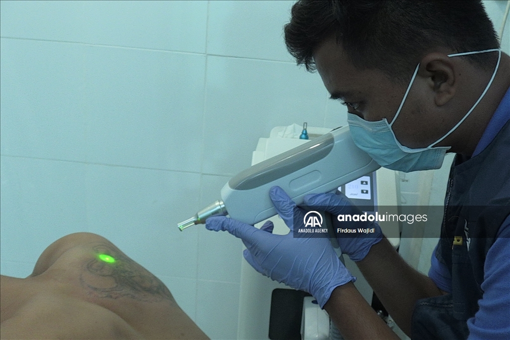 Program hapus tato gratis support Muslim untuk Hijrah